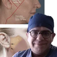 جشنواره پائیزان  جراحی لیفت صورت پیشانی شقیقه