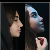 عمل جراحی بینی فقط 26 درکرج بدون تامپون(ENT)