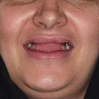 ایمپلنت زیبایی لمینت|خدمات آرایشگری و زیبایی|بازرگان, |دیوار