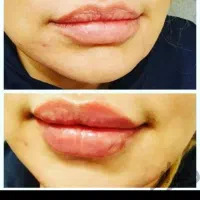 جشنواره آموزش ژل بوتاکس مزوتراپی تخفیف تا ۵۰٪