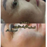 پلکسر پلاسما خالبرداری مزونیدلینگ مزووایت آموزش|خدمات آرایشگری و زیبایی|زاهدان, |دیوار