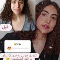 فیلر بیکینی ، لابیا پلاستی ترانسفر باسن بایوفیلر