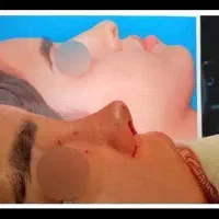 جراحی بینی فقط ۴۹ تومن