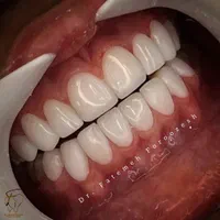 کامپوزیت دندان دندانپزشکی لمینت روکش ایمپلنت|خدمات آرایشگری و زیبایی|تهران, فردوس|دیوار