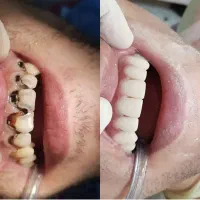 کامپوزیت دندان روکش لمینت با قیمت مناسب و اقساط|خدمات آرایشگری و زیبایی|ری, شهرری|دیوار