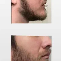 دستگاه اپلیکاتور ریش