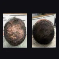 کامل بریز روش درمیاد