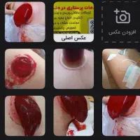 تزریقات و حجامت در منزل بیمار