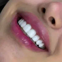 بلک فرایدی کامپوزیت دندان