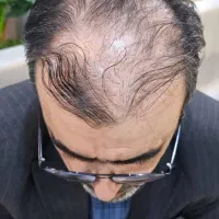 کاشت مو و ابرو با جدید ترین دستگاه های روز دنیا|خدمات آرایشگری و زیبایی|یاسوج, |دیوار