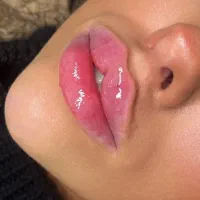 جشنواره ژل و بوتاکس و فیلر بادی و لیفت صورت