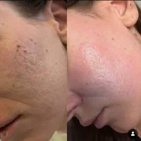 اسکین تراپیست.فیشیال پوست با توجه به مشکل|خدمات آرایشگری و زیبایی|نهاوند, |دیوار