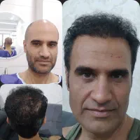 کاشت مو وابرو جشنواره ویژه|خدمات آرایشگری و زیبایی|یزد, |دیوار