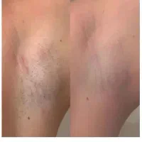 تخفیف لیزرکل بدن فقط۴۵۰ بمناسبت روزمادر تست رایگان