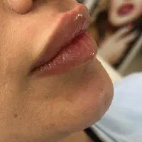مدل فیلر