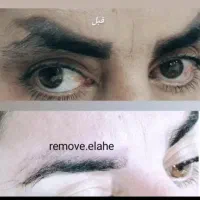 ریموو تک جلسه ای تضمینی|خدمات آرایشگری و زیبایی|مهران (ایلام), |دیوار
