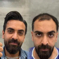 کاشت مو تضمینی در یک جلسه با تکنیک شیرازی|خدمات آرایشگری و زیبایی|یزد, |دیوار