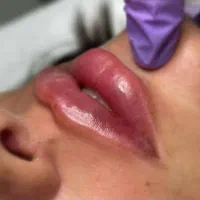 تزریق ژل و بوتاکس و prp صورت و مزو مو|خدمات آرایشگری و زیبایی|سبزوار, جوادیه شرقی|دیوار