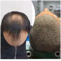 روش جدید بدون جراحی فول تراکم|خدمات آرایشگری و زیبایی|آمل, |دیوار