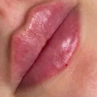 تزریق ژل و بوتاکس|خدمات آرایشگری و زیبایی|لامرد, |دیوار