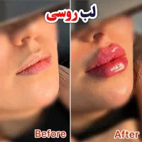 جشنواره یلدایی تزریق ژل فیلر بوتاکس مزوتراپی اقساط