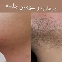 الکترولیز موهای سفید و مشکی، خال برداری