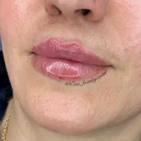 تزریق ژل و بوتاکس و مزوها با تکنیک های جدید