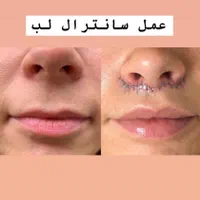 بلفارو، بوتاکس، ژل، هایفو، ساکشن شکم و غبغب