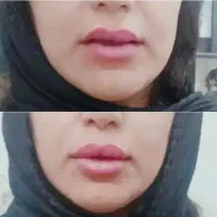 تزریق ژل وبوتاکس ژل لب گونه چانه زاویه خط لبخند|خدمات آرایشگری و زیبایی|کرمانشاه, |دیوار