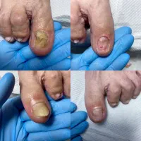 کفسابی پا.درمان ناخن پا.میخچه. ارتونیل ناخن پا|خدمات آرایشگری و زیبایی|کرج, کوی امامیه|دیوار