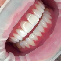 جشنواره ویژه دندان مصنوعی و...فقط 15 تومن