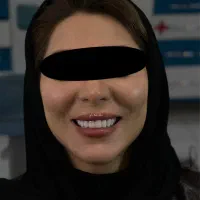 کامبوزیت زیبایی کامپوزیت دندان ضمانت ۵ ساله