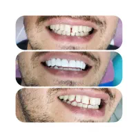 کامپوزیت فقط فکی ۱۶ تومن وآموزش  روز کامپوزیت|خدمات آرایشگری و زیبایی|تهران, شمشیری|دیوار