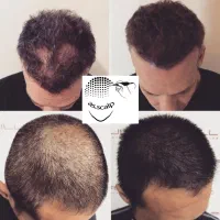 راز پرپشتی موهای سلبریتی ها (میکرواسکالپ/اسکالپ)