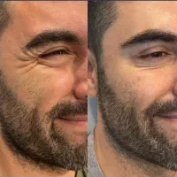 جشنواره تخفیف ۵۰ درصدی بوتاکس آقایان