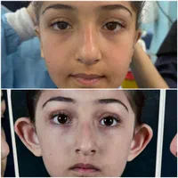 عمل افتادگی پلک بالا/اتو پلاستی (گوش)/اقساط|خدمات آرایشگری و زیبایی|بوشهر, |دیوار