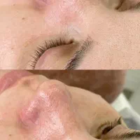 پاکسازی و فشیال پوست