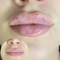 تزریق فیلر و بوتاکس