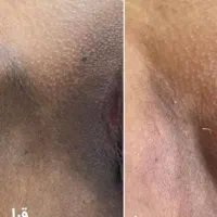 جشنواره یلدایی ژل بوتاکس پی ارپی فیلر بیکینی|خدمات آرایشگری و زیبایی|مشهد, سرافرازان|دیوار