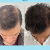 درماژن پیازچه مو