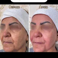 هایفو تراپی/پلاژن تراپی/کربوکسی/لیزربدن