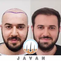 کاشت مو ابرو بلفاروپلاستی مزو تراپی پی آرپی