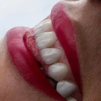 ایمپلنت8 تومن/کامپوزیت2تومن/عصب کشی/لمینت|خدمات آرایشگری و زیبایی|مشهد, سجاد شهر|دیوار