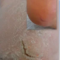 پدیکورو کفسابی تخصصی واپیلاسیون تخصصی با موم دائم