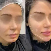 تزریق ژل و بوتاکس از ۷۹۹|خدمات زیبایی و سلامت|تهران, شهرک ولیعصر جنوبی|دیوار