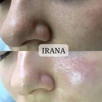 سفیدکردن بیکینی،زیربغل،صورت (کلینیک ایرانا)|خدمات آرایشگری و زیبایی|یاسوج, |دیوار