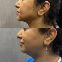 تخلیه غب غب|خدمات آرایشگری و زیبایی|خرم‌آباد, |دیوار