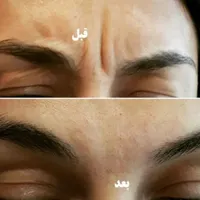 خط اخم و چروک پیشانی
