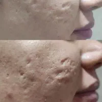 بهترین مرکز کربن تراپی (پلینگ هالیوودی )در شیراز