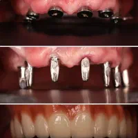 جشنواره دندانپزشکی ، ایمپلنت فقط ۱۰/۳۰۰|خدمات آرایشگری و زیبایی|تبریز, |دیوار